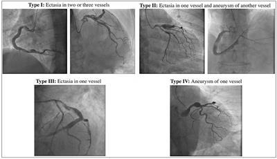 Treatment and Outcome of Patients With Coronary Artery Ectasia: Current Evidence and Novel Opportunities for an Old Dilemma